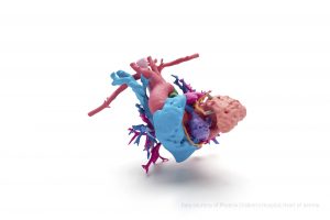 This  full color model is a hear t of a young girl named Jemma with a complex heart defect; the heart was  printed using HP &rsquo; s new Jet Fusion 300 / 500 3D printer to help surgeons at Phoenix Children &rsquo; s Hospital  prepare, select the best surgical path and explain the procedure to Jemma &rsquo; s fami ly. * Credit required as follows: Data courtesy of Phoenix Children &rsquo; s Hospital; Heart of Jemma